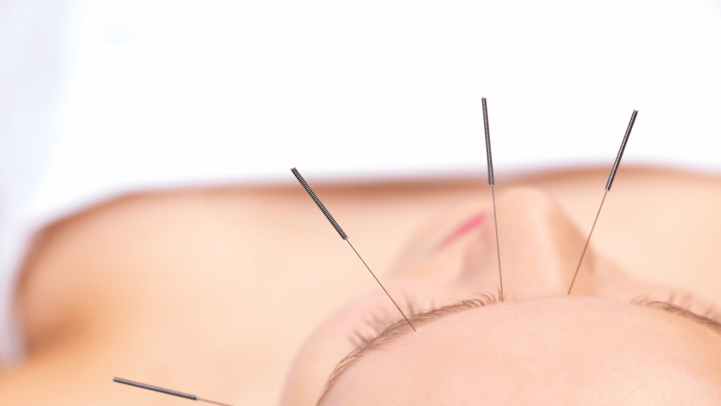 Electro-muscular Dry Needling. What is it? - Intune Sports